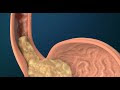 Acid Reflux Disease - The Big Lie