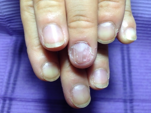 鶴ヶ島市の深爪矯正 ネイルサロン Nailspace Kisskiss 美爪矯正 ネイルサロン 鶴ヶ島 育爪 深爪さん