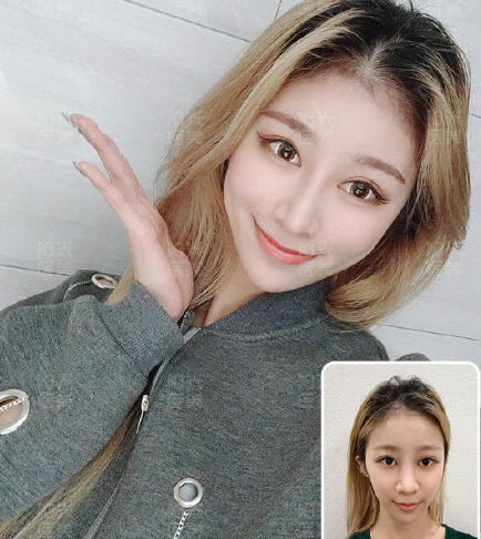 罗志敏和朱灿哪个鼻子做得好 朱灿罗志敏隆鼻技术怎么样 整容资讯网