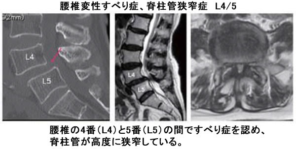 腰椎変性すべり症 ご来院の方へ 金沢脳神経外科病院