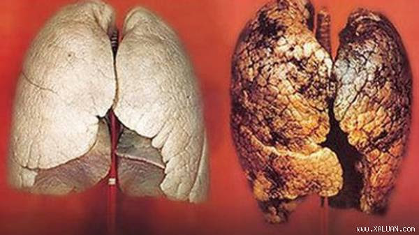  Ung thư phổi là căn bệnh có tỷ lệ tử vong cao ở Việt Nam và cả trên thế giới. Ảnh: VietQ