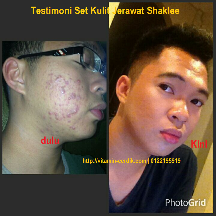 Kulit Jerawat – samyysandra.com