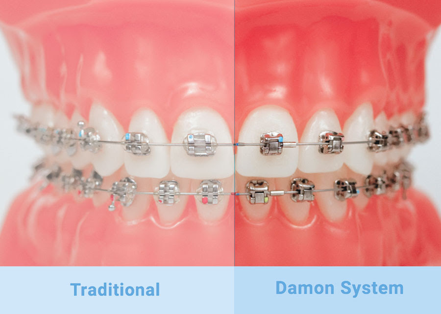 Damon Self-Ligating brackets - Valerian Orthodontics