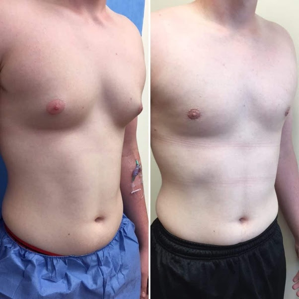 Male Breast Reduction Guide ABCS