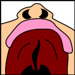 Plik:Cleftpalate3.png