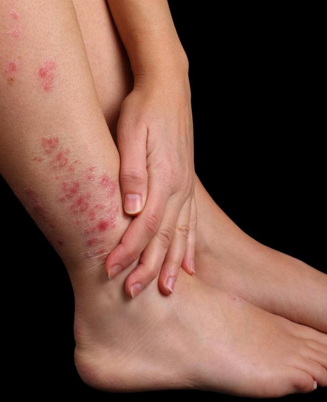What Are the Most Common Causes of Leg Rashes? (with pictures)