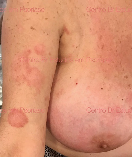 Fotos E Imagens De Psoriase Portal Clinica Sabbag E Centro Brasileiro De Estudos Em Psoriase