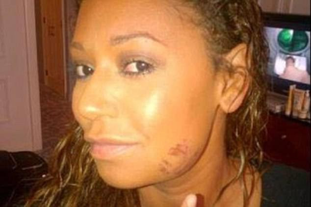Bruised: Mel has catalogued a history of violence against estranged husband Stephen Belafonte in a court filing as she obtained a retraining order against him on Monday 