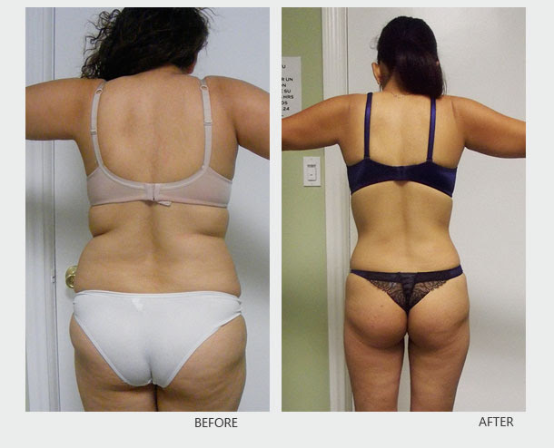 Back &gt; Galleries For &gt; Cellulite Treatment Before And After