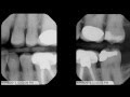 Tips and Tricks for Bitewing X-Rays
