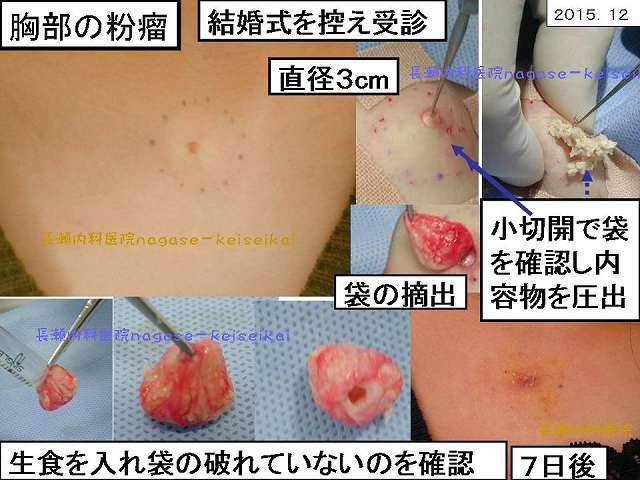 粉瘤 ふんりゅう 表皮嚢腫 ひょうひのうしゅ アテローマ アテローム 粉瘤１ 医療法人恵生会 長瀬内科医院