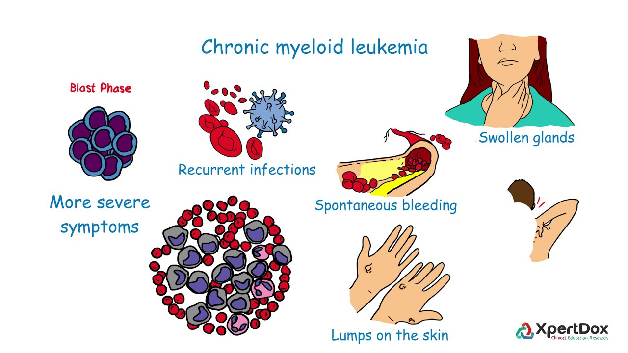 Chronic myeloid leukemia prognosis