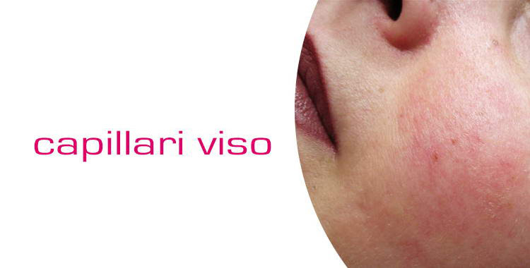 laser capillari viso