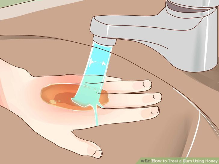 Treat a Burn Using Honey Step 15.jpg