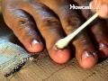 [コンプリート！] fungal infection under fingernail 341440-Fungal infection under fingernail