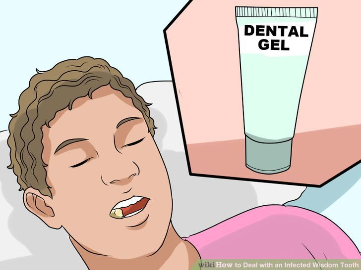 Deal with an Infected Wisdom Tooth Step 3 Version 2.jpg