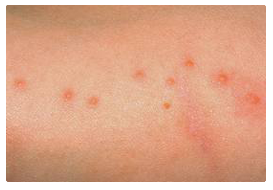 Bed Bug Bite Images and Bed Bug symptoms