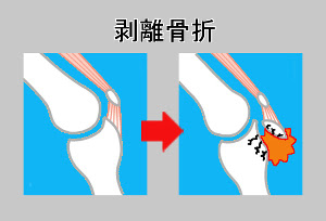 剥離 はくり 骨折 裂離 れつり 骨折について 那須塩原の接骨院 いくた接骨院