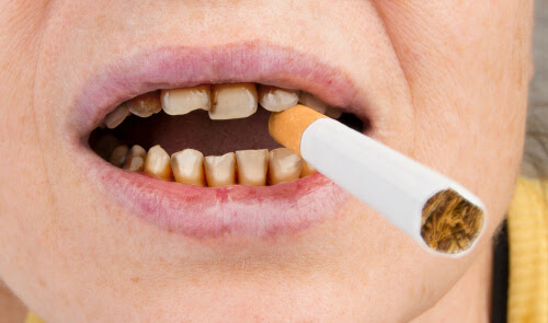 Does tobacco stain teeth? Nicotine and tar are to blame