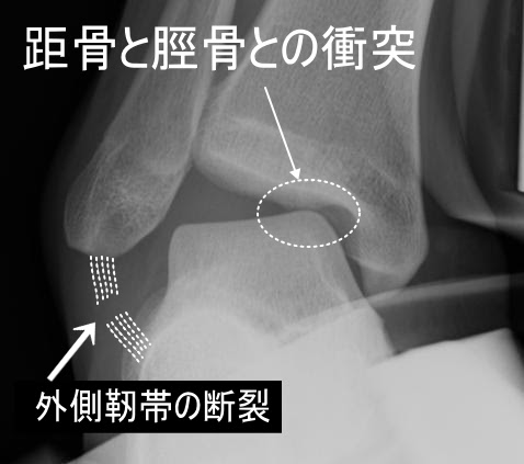 足首の奥が痛む 距骨離断性骨軟骨炎 よくある症状 疾患 札幌スポーツクリニック 札幌市中央区の整形外科 内科 リハビリ科