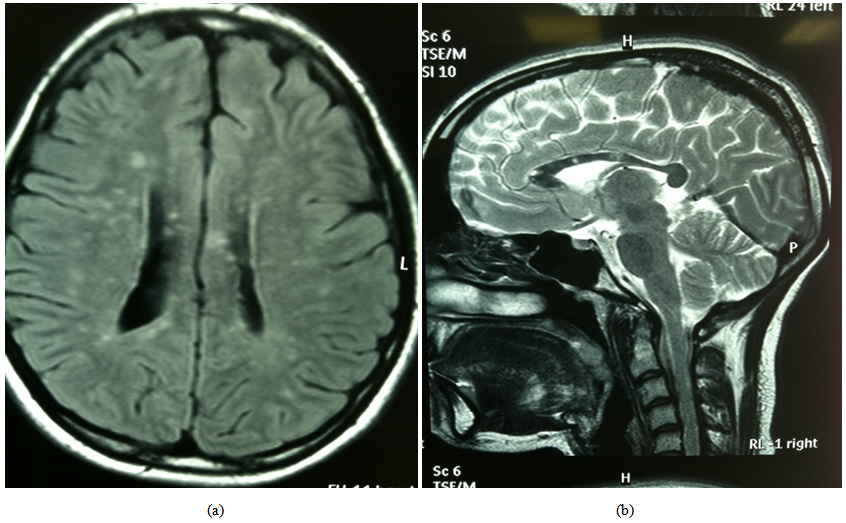 Susac S Syndrome Is It Really A Rare Disorder