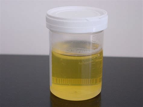 Colored urine is usually a sign of infection, particularly urinary tract infections. primary health station cloudy foamy urine is it proteinuria