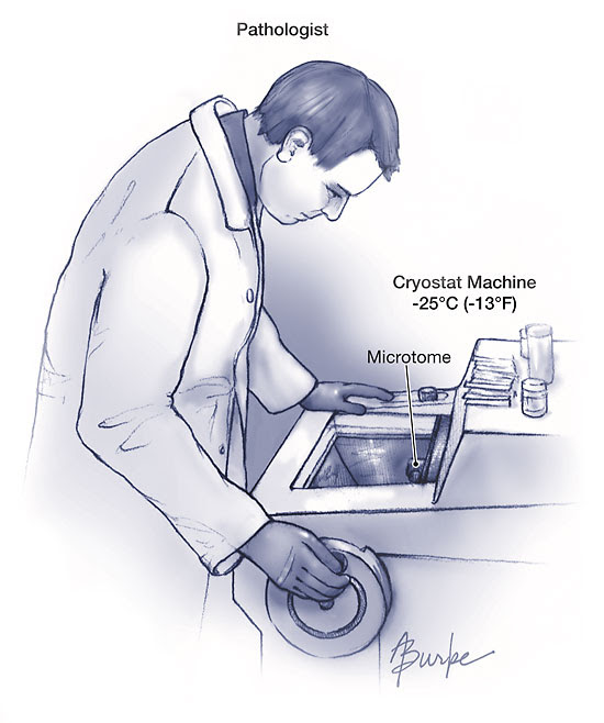 Frozen Section Biopsy  Surgery  JAMA  The JAMA Network