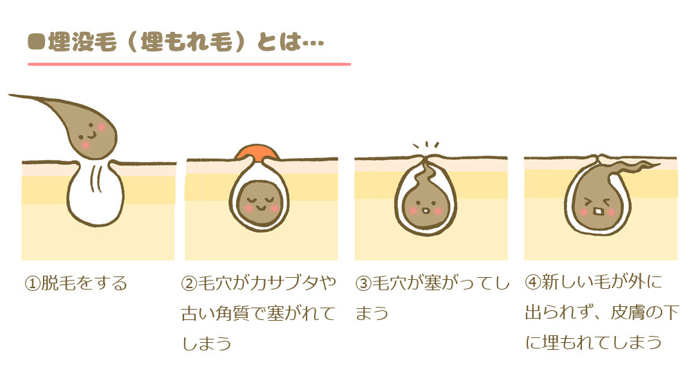埋没毛 ブラジリアンワックス脱毛の代表的なトラブルを解消する方法 アンジェリカ コラム