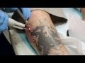 What Does Your Skin Look Like After Tattoo Removal - Duolite Q-Switched Laser - High Tech Laser : When someone has a tattoo removed do you cover the entire area of ink or is the tattoo removed in sections.