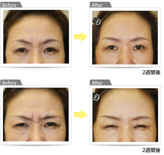 ボトックス注射 紀尾井町ブラザクリニック