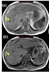 Early Stage Colon Cancer Causes - Early Hepatocellular Carcinoma: Diagnosing the Difficult : A diagnosis of lung cancer naturally causes some overwhelming emotions, but you don’t have to let those emotions get the best of you.