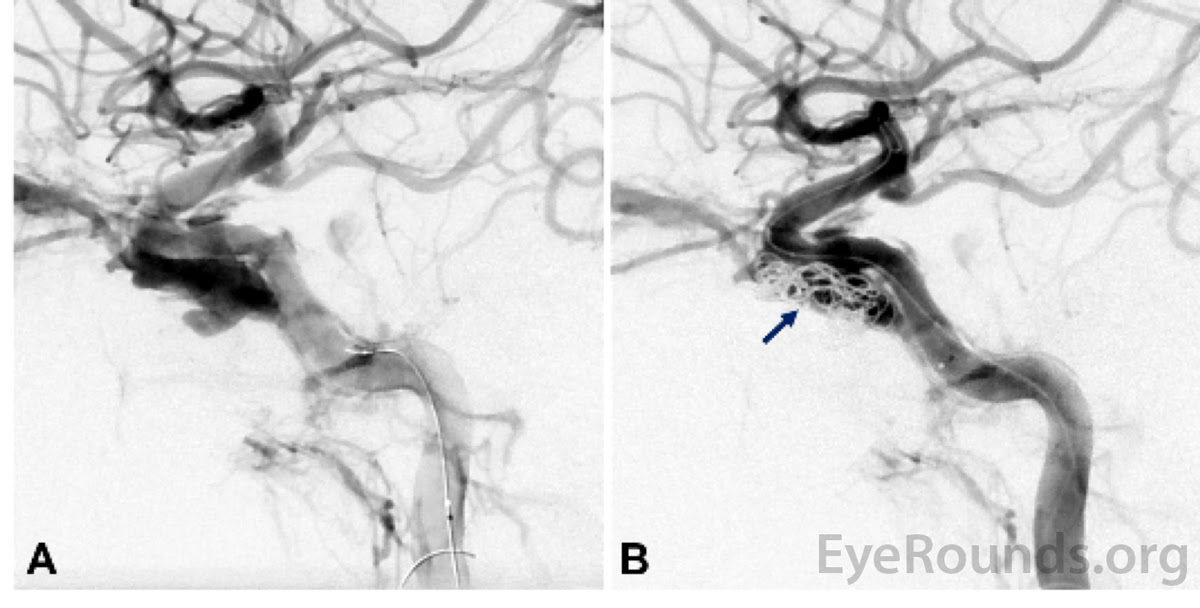 Carotid Cavernous Fistula