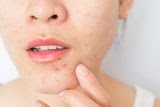 9 of the Best (and Easiest) DIY Acne Hacks We Found on TikTok