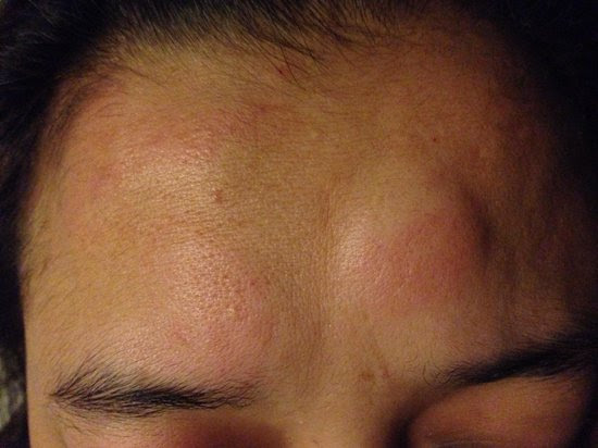 Forehead bitten by the bed bugs - Picture of Patong Backpacker Hostel ...
