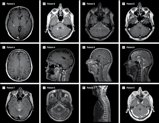 Long-term Outcomes of CLIPPERS (Chronic Lymphocytic ...