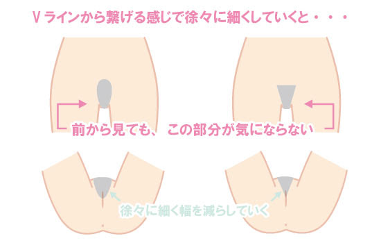 ｉラインはどこまで脱毛 Vioの処理 ｉラインの形って全部なくす 一部残す 脱毛サロンでお肌ツルッ