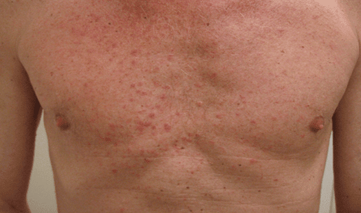 Lung Cancer Skin Rash Pictures / Lung Cancer Symptoms Signs Of A Tumour Include An Itchy Rash On Your Skin Express Co Uk : We’ll help you identify different rashes, tell you about some possible causes for r.