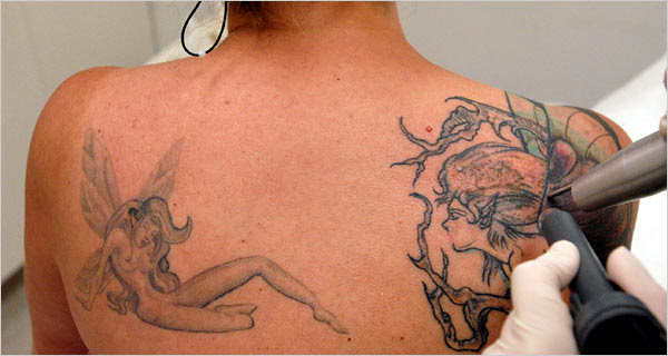 Erasing Tattoos, Out of Regret or for a New Canvas