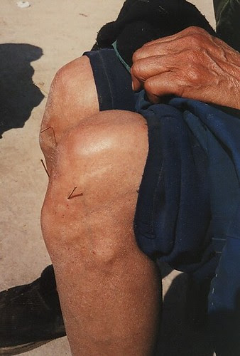 Acupuncture knees