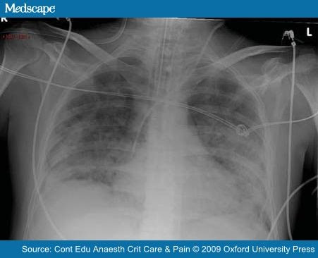 transfusion related acute lung injury. Acute Lung Injury and Acute