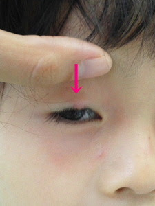 霰粒腫 読めないよね はなとハルとソウ