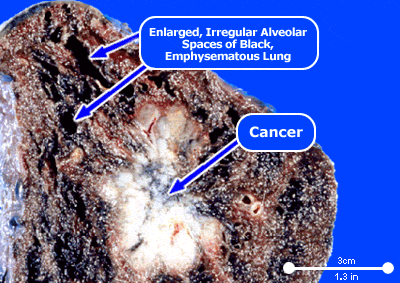Picture of lung cancer
