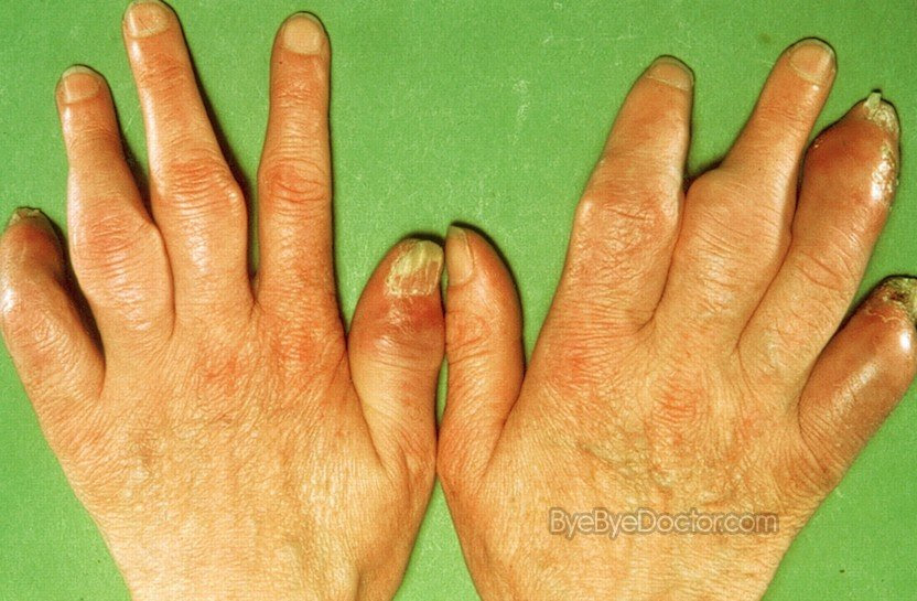 dactylitis pictures 4 dactylitis
