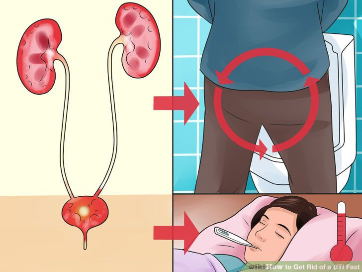 Get Rid of a UTI Fast Step 2 Version 2.jpg