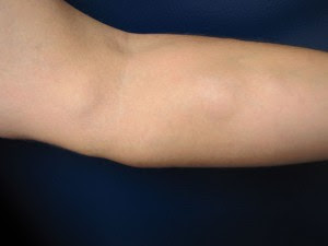 Lump under skin on arm