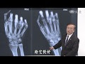 【ベストコレクション】 舟状骨骨折 全治 253412