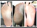 Baby Foot Peel Mask