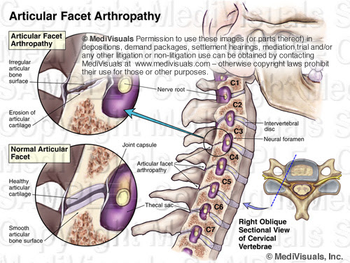 Arthropathy