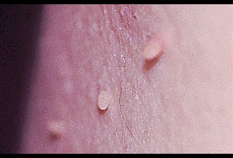 skin tag picture image  medicinenetcom