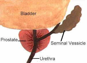 Uretra ingrossata